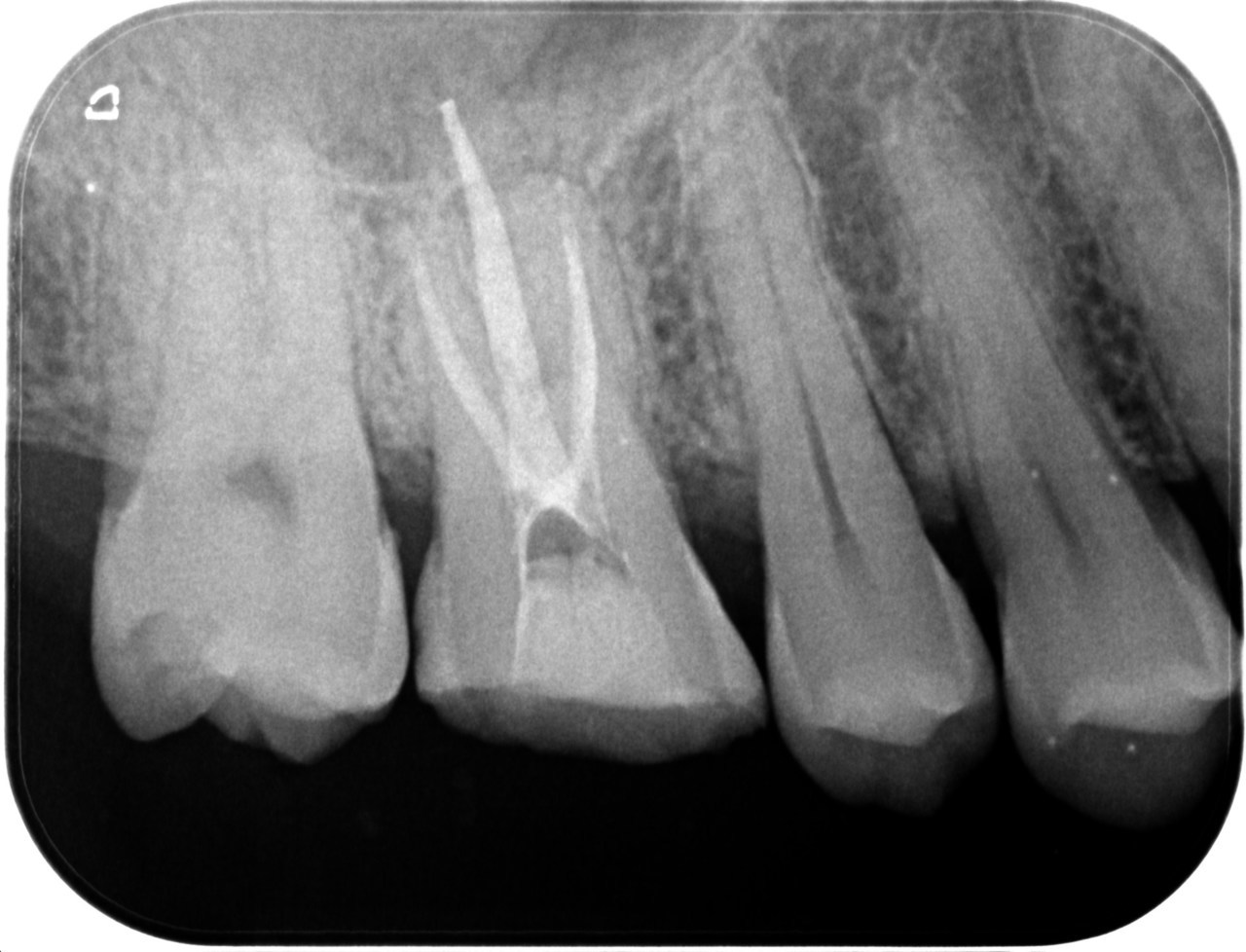 歯 の 亀裂 治療
