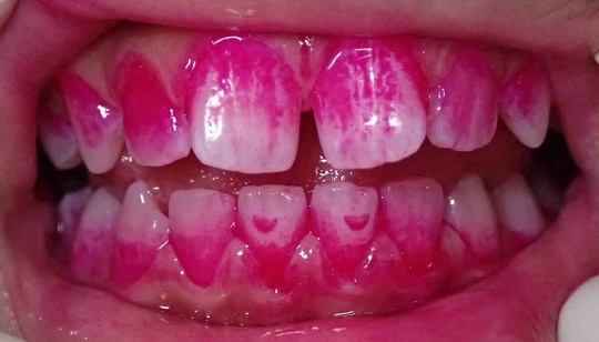 深い虫歯 ファミリーはら歯科医院 八千代市 八千代緑が丘